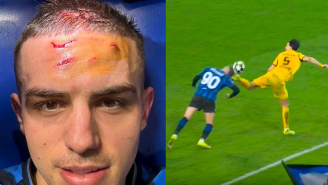 Nikola Krstović von Atalanta zeigt nach einem dramatischen Elfmeter in letzter Minute gegen BVB seine Stirn.